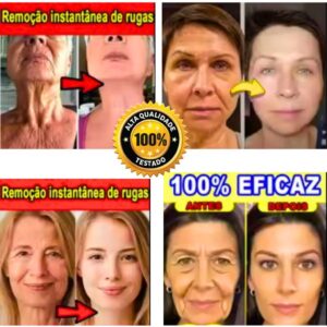 Ácido Hialurônico + Fios de Proteína Anti Rugas /Linhas de Expressão/Rejuvenescedor Facial