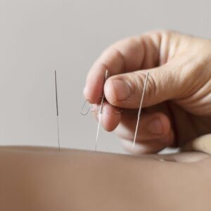 Agulha para Acupuntura Uniqmed 1000 Agulhas Reg. Anvisa